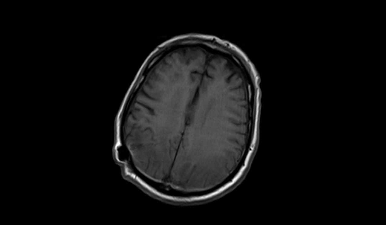 Posterior Reversible Encephalopathy Syndrome (PRES) | Radiology Article ...