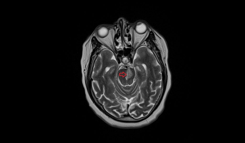 Acute Pontine Infarct MRI | Radiology Article on Acute Pontine stroke MRI