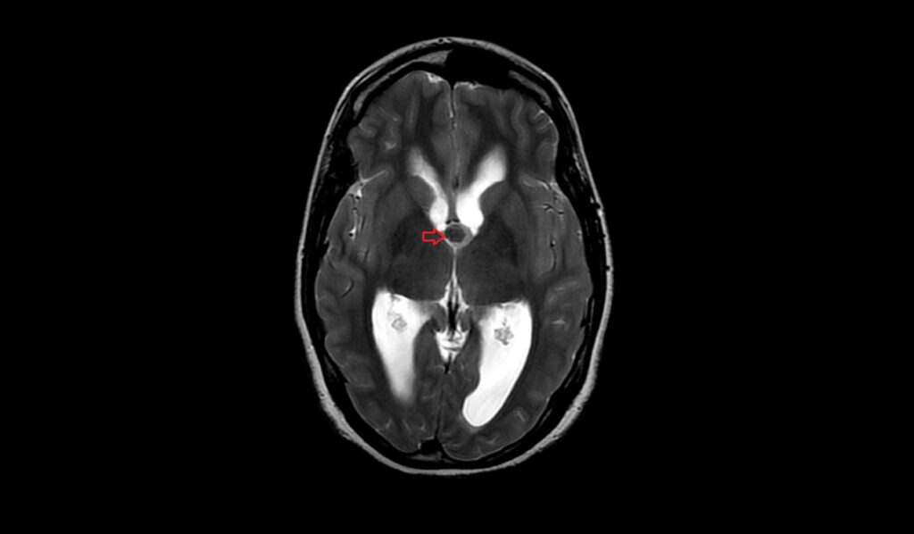 Colloid cyst MRI | Radiology Article on Colloid Cyst of the Foramen of ...