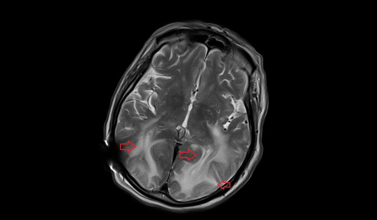 Posterior Reversible Encephalopathy Syndrome (PRES) | Radiology Article ...