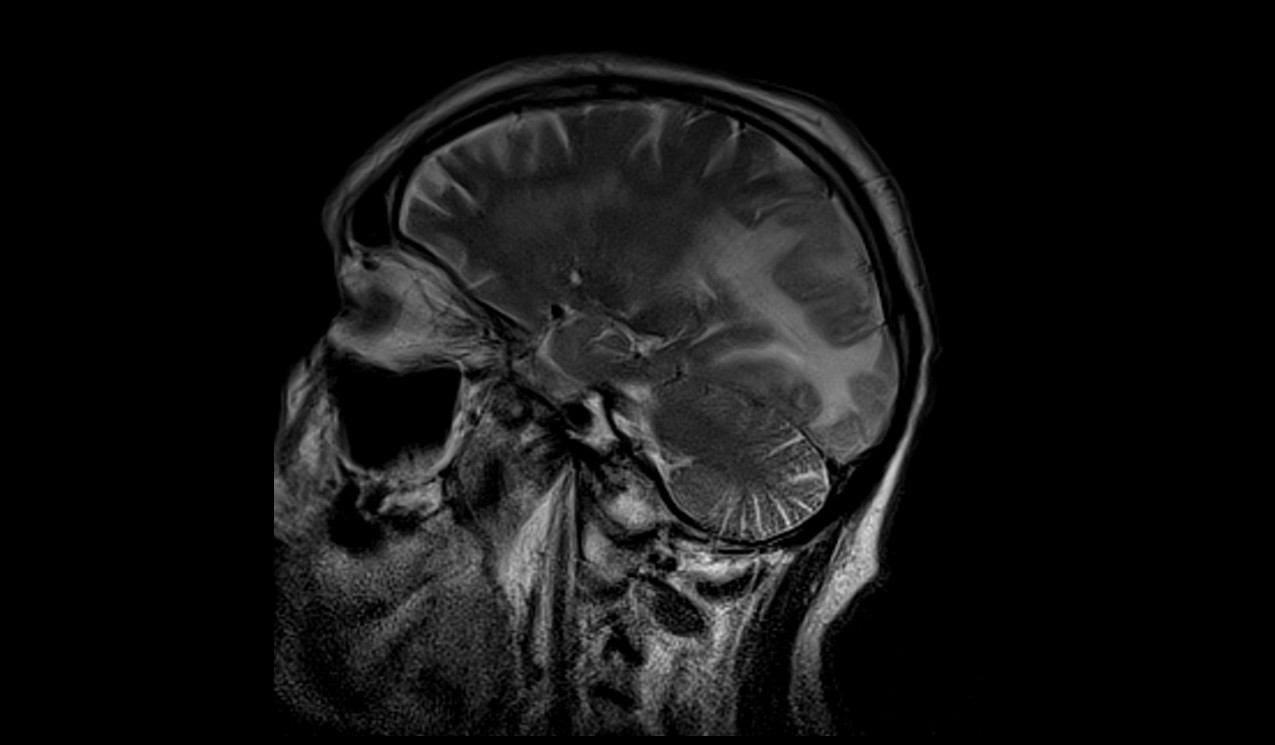 Posterior Reversible Encephalopathy Syndrome (PRES) | Radiology Article ...