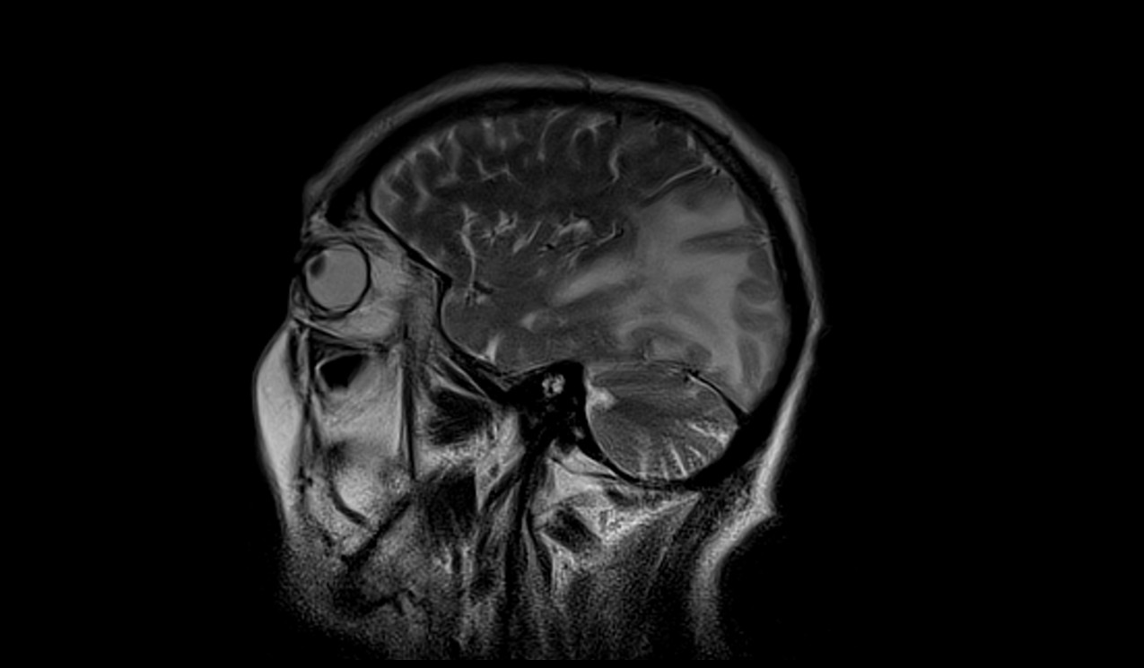 Posterior Reversible Encephalopathy Syndrome (PRES) | Radiology Article ...