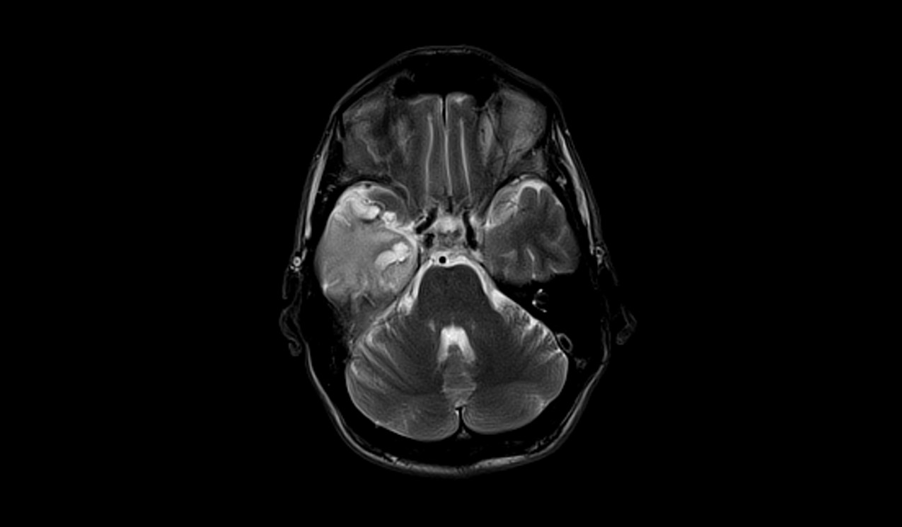 MRI Encephalitis | Radiology article on herpes simplex encephalitis