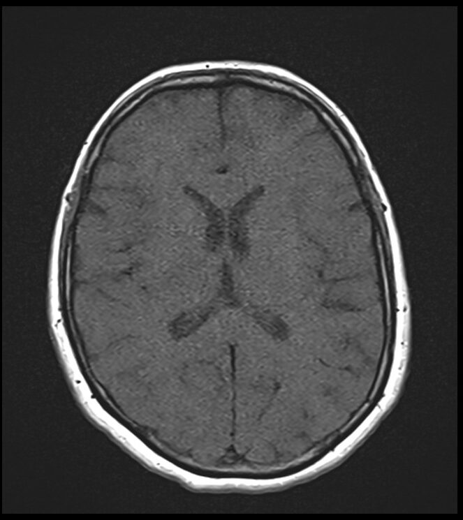 TR and TE in MRI | TR (repetition time),TE (echo time) and image contrast