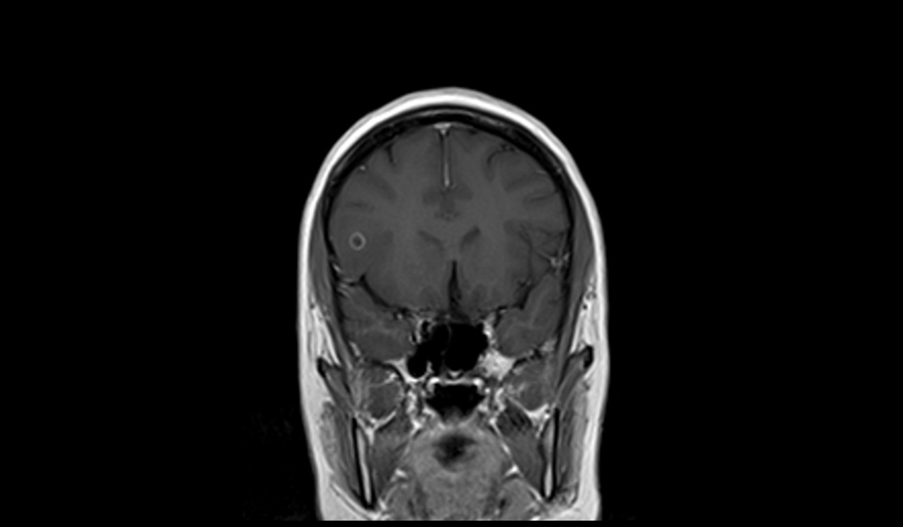 Neurocysticercosis MRI | Radiology Article on Neurocysticercosis