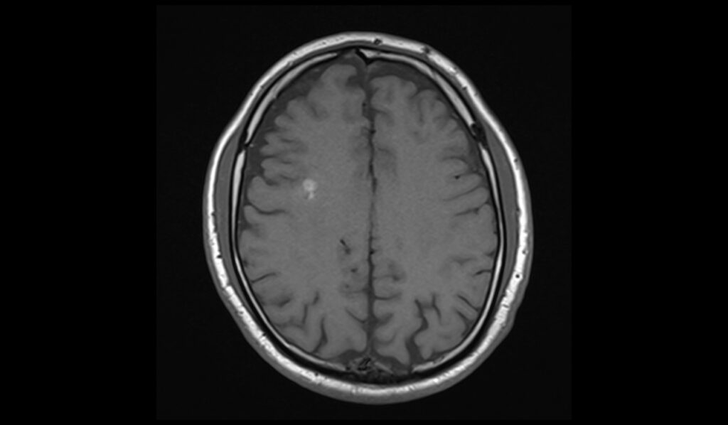 Cavernoma MRI | Radiology Article on Cavernous Hemangioma