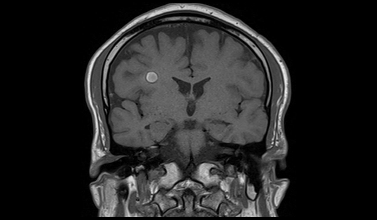 Cavernoma MRI | Radiology Article on Cavernous Hemangioma