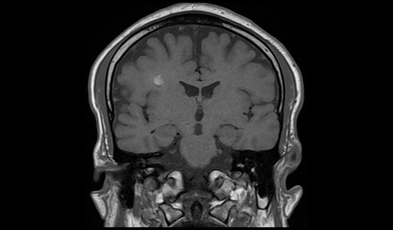 Cavernoma MRI | Radiology Article on Cavernous Hemangioma