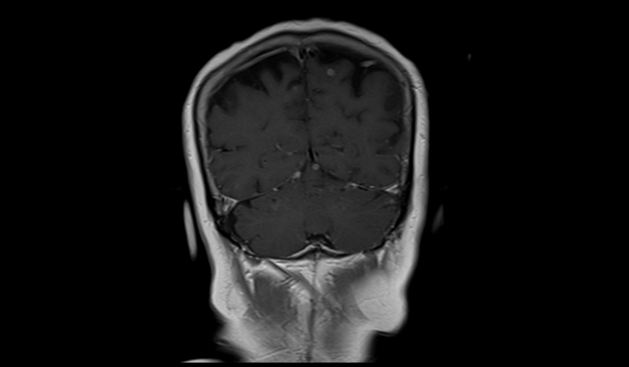 Tuberculoma MRI | Radiology Article on Brain Tuberculoma