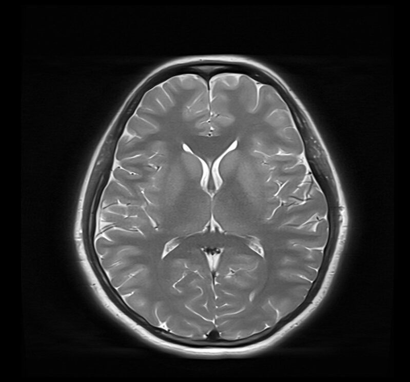 TR and TE in MRI | TR (repetition time),TE (echo time) and image contrast