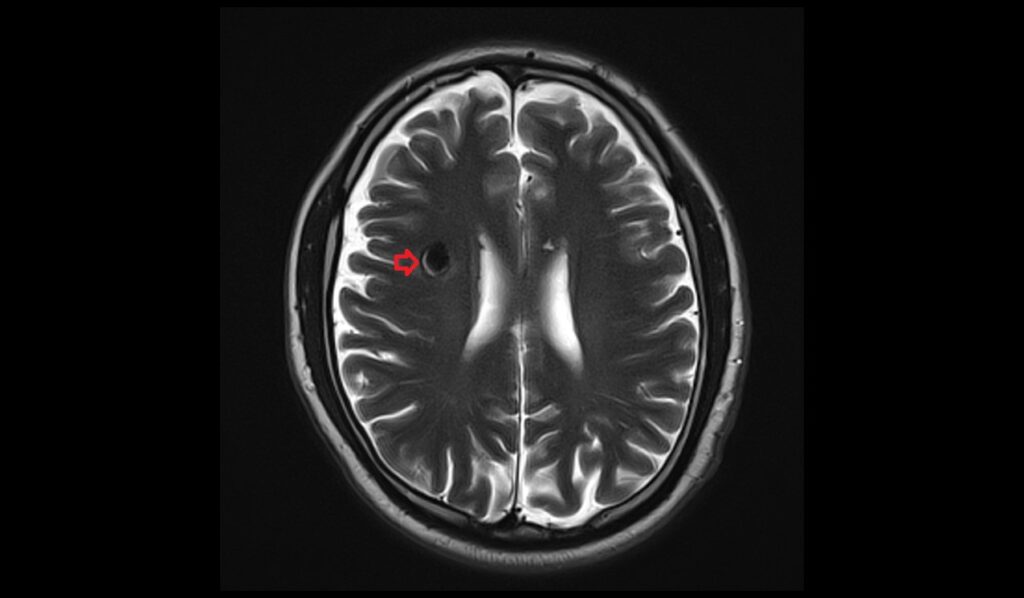 Cavernoma MRI | Radiology Article on Cavernous Hemangioma