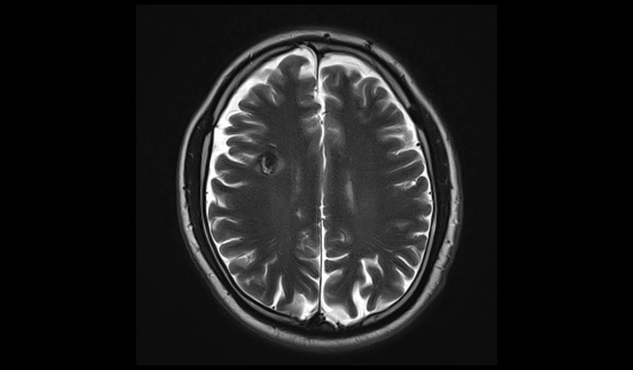 Cavernoma MRI | Radiology Article on Cavernous Hemangioma