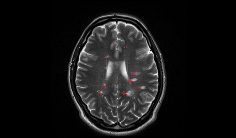Multiple sclerosis(MS) MRI | Radiology Article on Multiple sclerosis