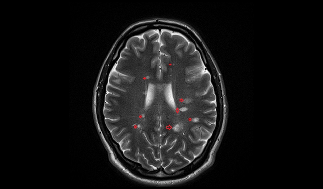 Multiple sclerosis(MS) MRI | Radiology Article on Multiple sclerosis
