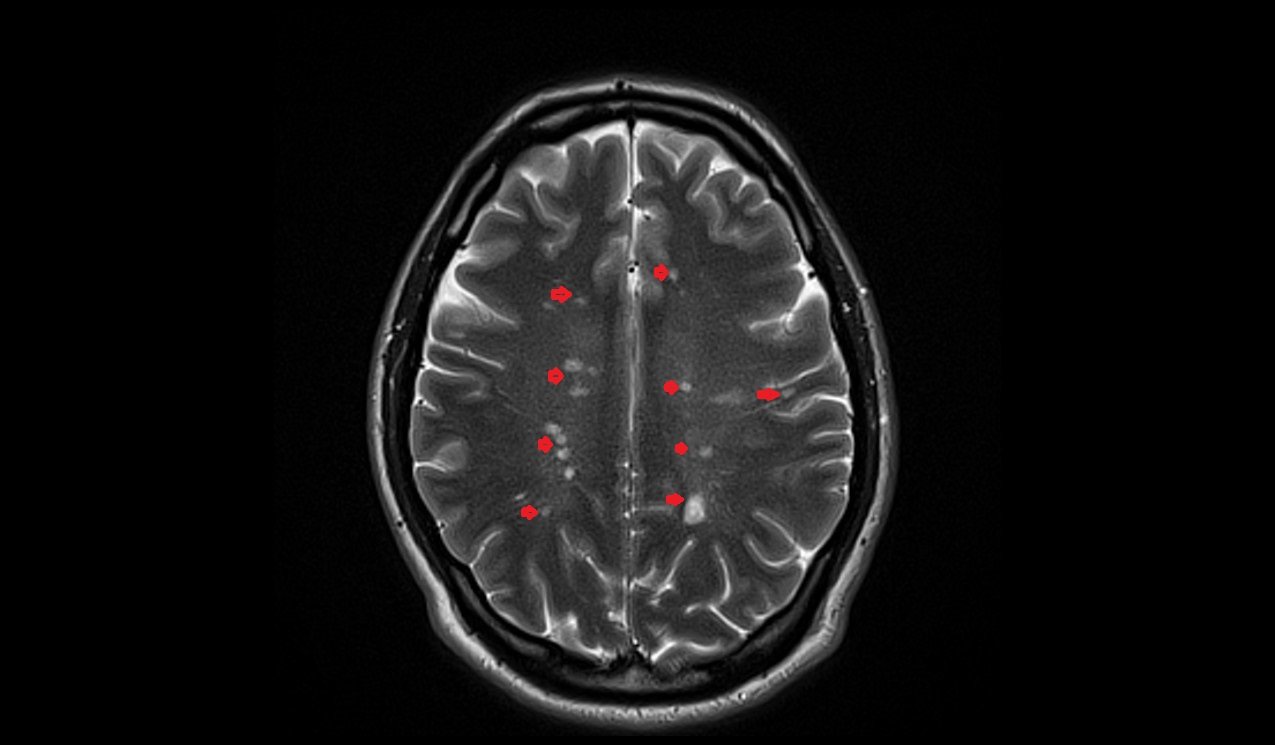 Magnims Score Multiple sclerosis(MS) MRI | Radiology Article on Multiple sclerosis