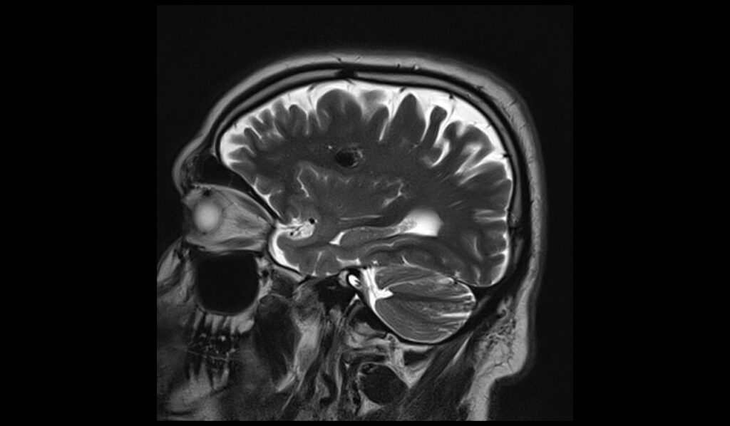 Cavernoma MRI | Radiology Article on Cavernous Hemangioma