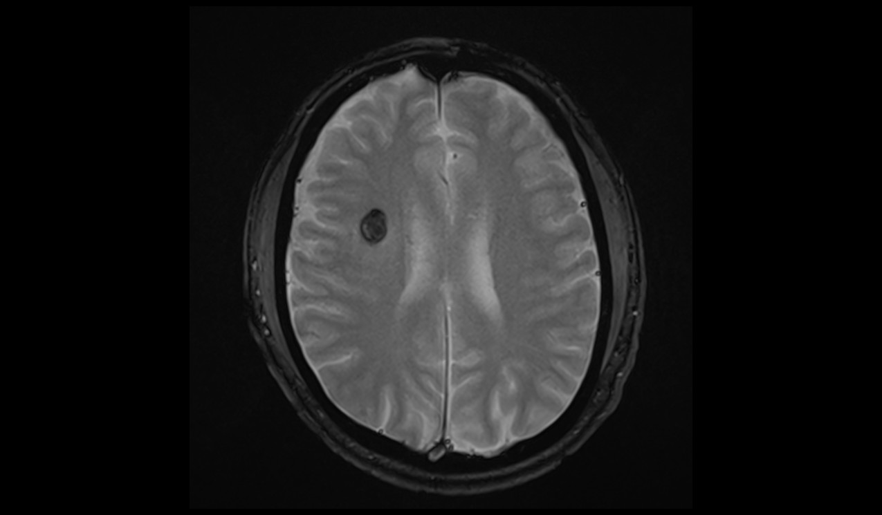 Cavernoma MRI | Radiology Article on Cavernous Hemangioma