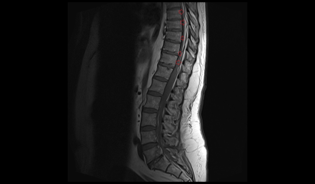 Spinal epidural hematoma MRI | Radiology article on Spinal epidural ...