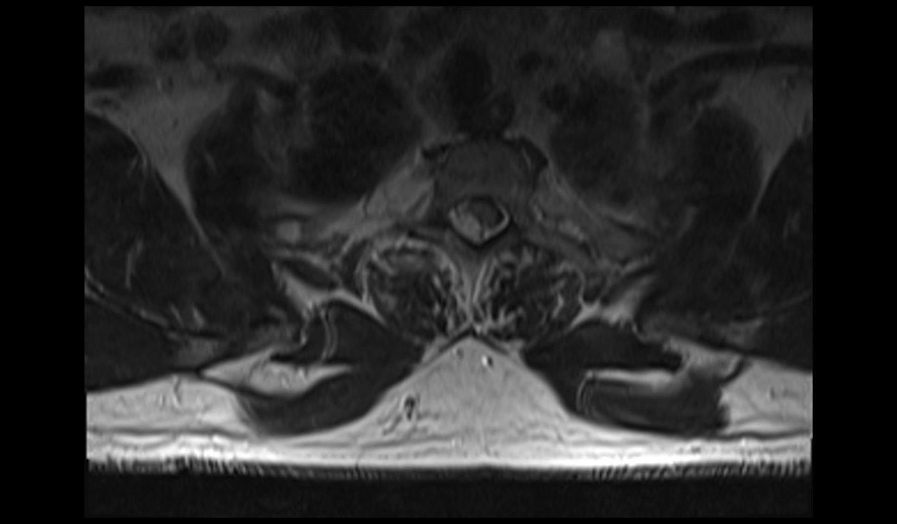 Spinal Epidural Hematoma MRI Radiology Article On Spinal Epidural spinal-epidural-hematoma-mri-radiology-article-on-spinal-epidural
