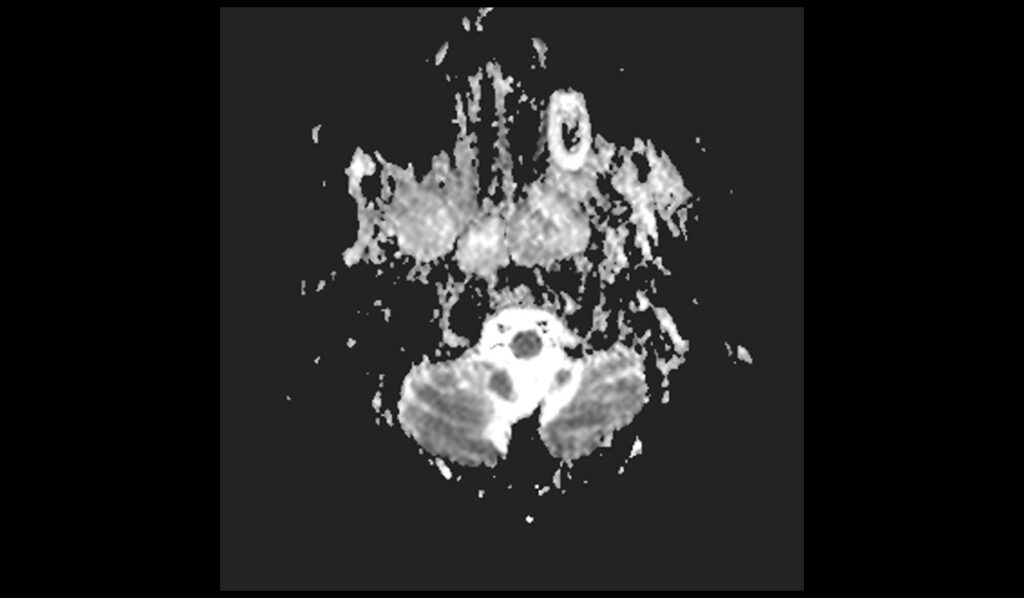 Clival Chordoma MRI | Radiology Article on Clival Chordoma