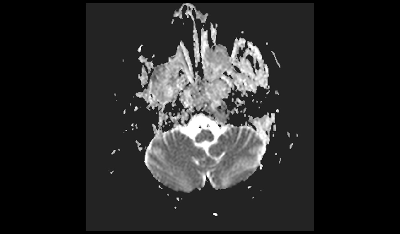 Clival Chordoma MRI | Radiology Article on Clival Chordoma