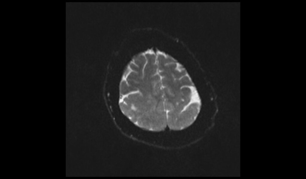 Pachygyria MRI | Radiology Article on Oligodendroglioma