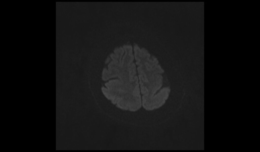 Pachygyria MRI | Radiology Article on Oligodendroglioma