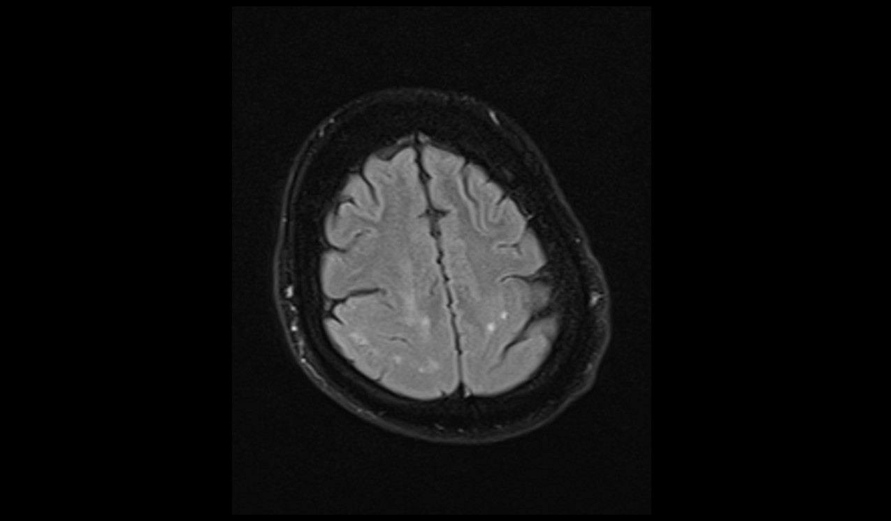 Pachygyria MRI | Radiology Article on Oligodendroglioma