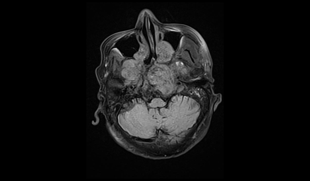 Clival Chordoma MRI | Radiology Article on Clival Chordoma