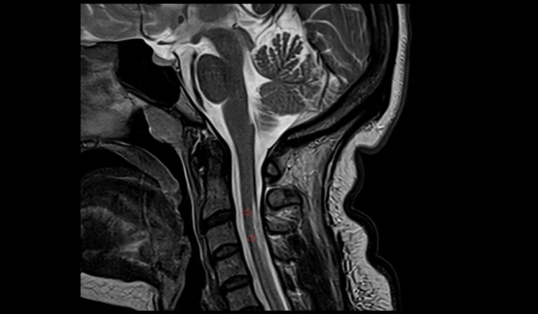 Nitrous oxide toxicity spinal cord MRI | Radiology article on Nitrous ...