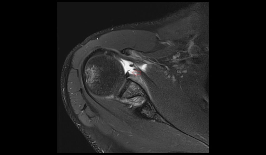 ALPSA Lesion MRI | Radiology Article on Anterior Labroligamentous ...