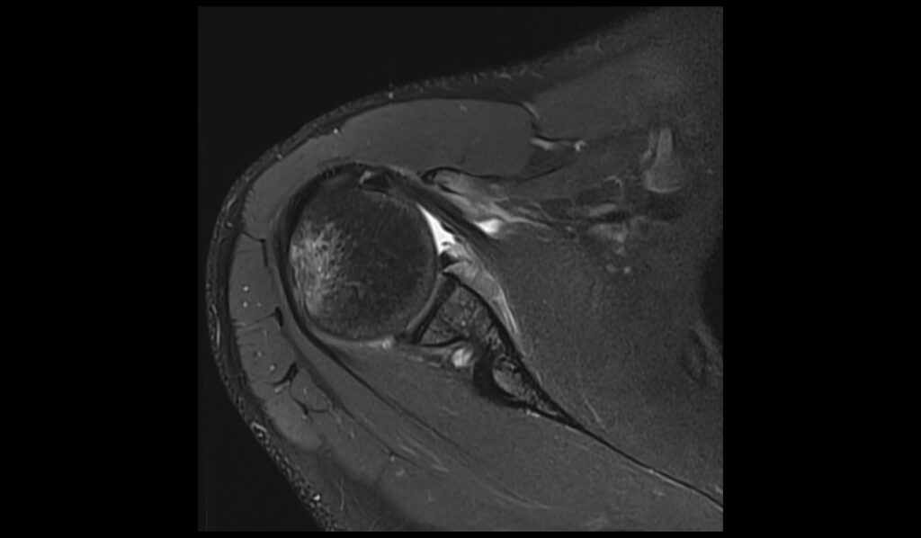 ALPSA Lesion MRI | Radiology Article on Anterior Labroligamentous ...