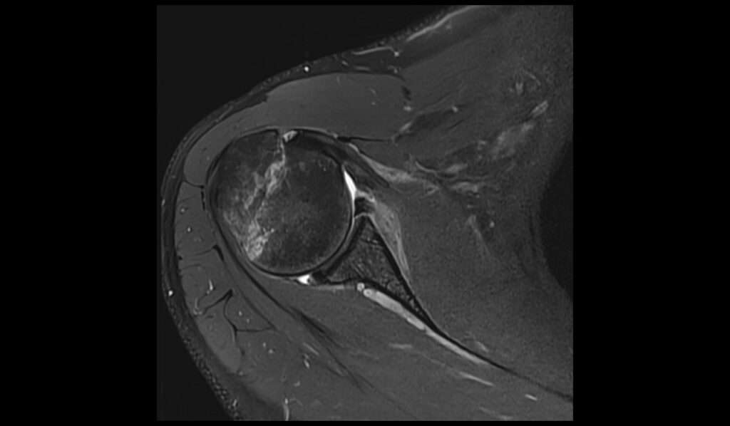 ALPSA Lesion MRI | Radiology Article on Anterior Labroligamentous ...