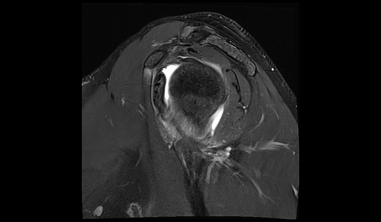ALPSA Lesion MRI | Radiology Article on Anterior Labroligamentous ...