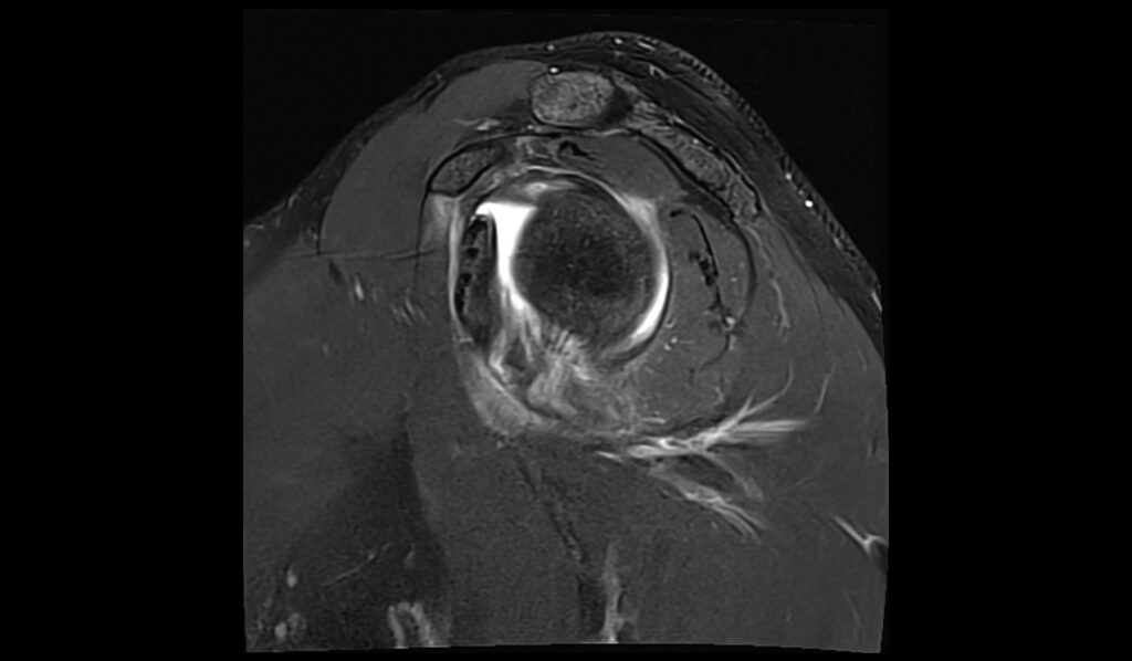 ALPSA Lesion MRI | Radiology Article on Anterior Labroligamentous ...