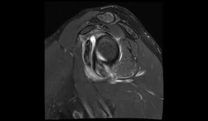 ALPSA Lesion MRI | Radiology Article on Anterior Labroligamentous ...