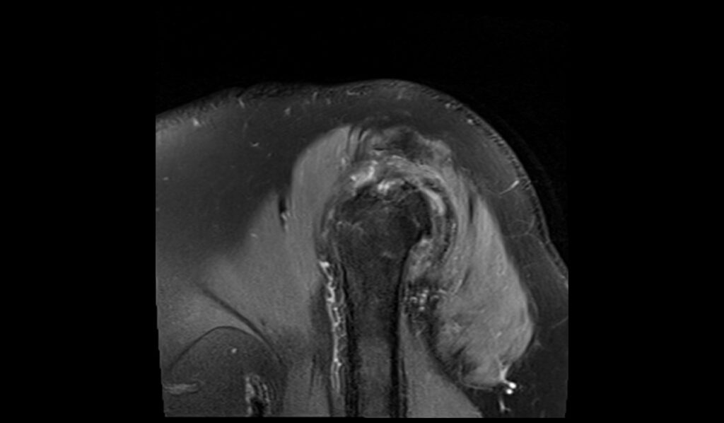 Greater Tuberosity Avulsion Fracture Mri 