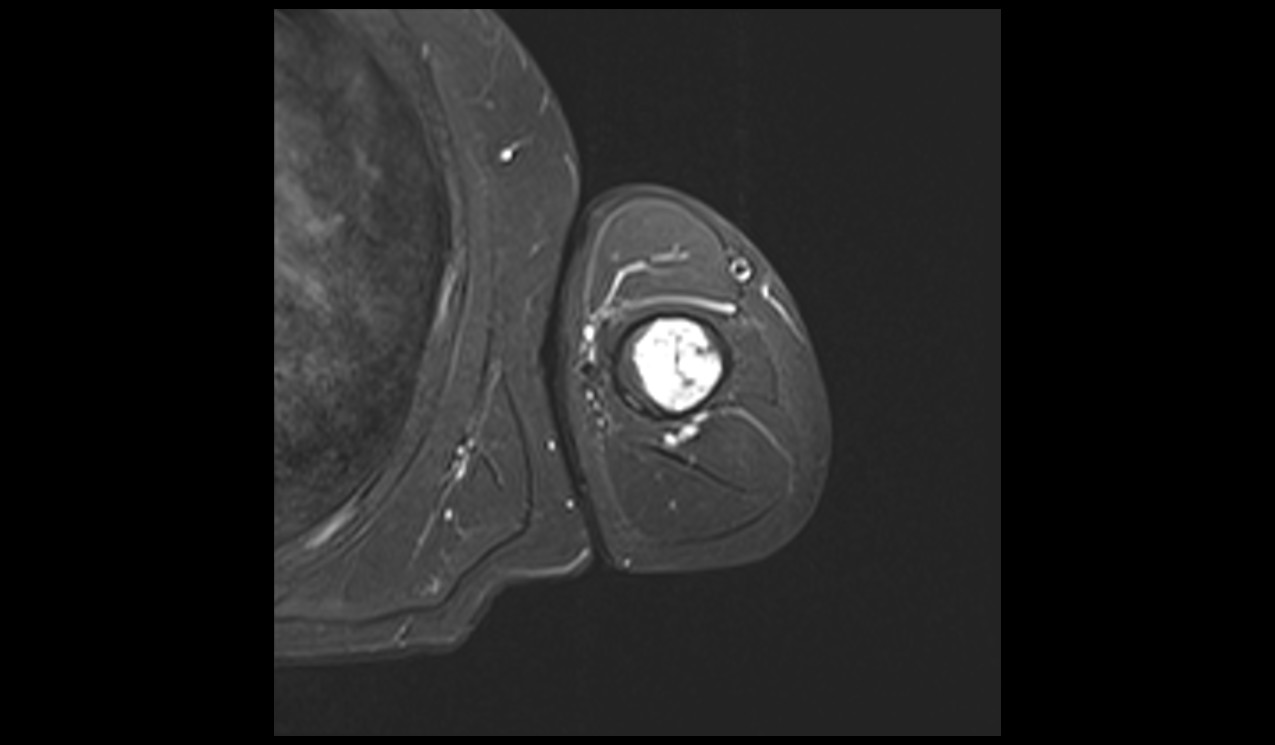 Polyostotic Fibrous Dysplasia Mri Radiology Article On Polyostotic Fibrous Dysplasia