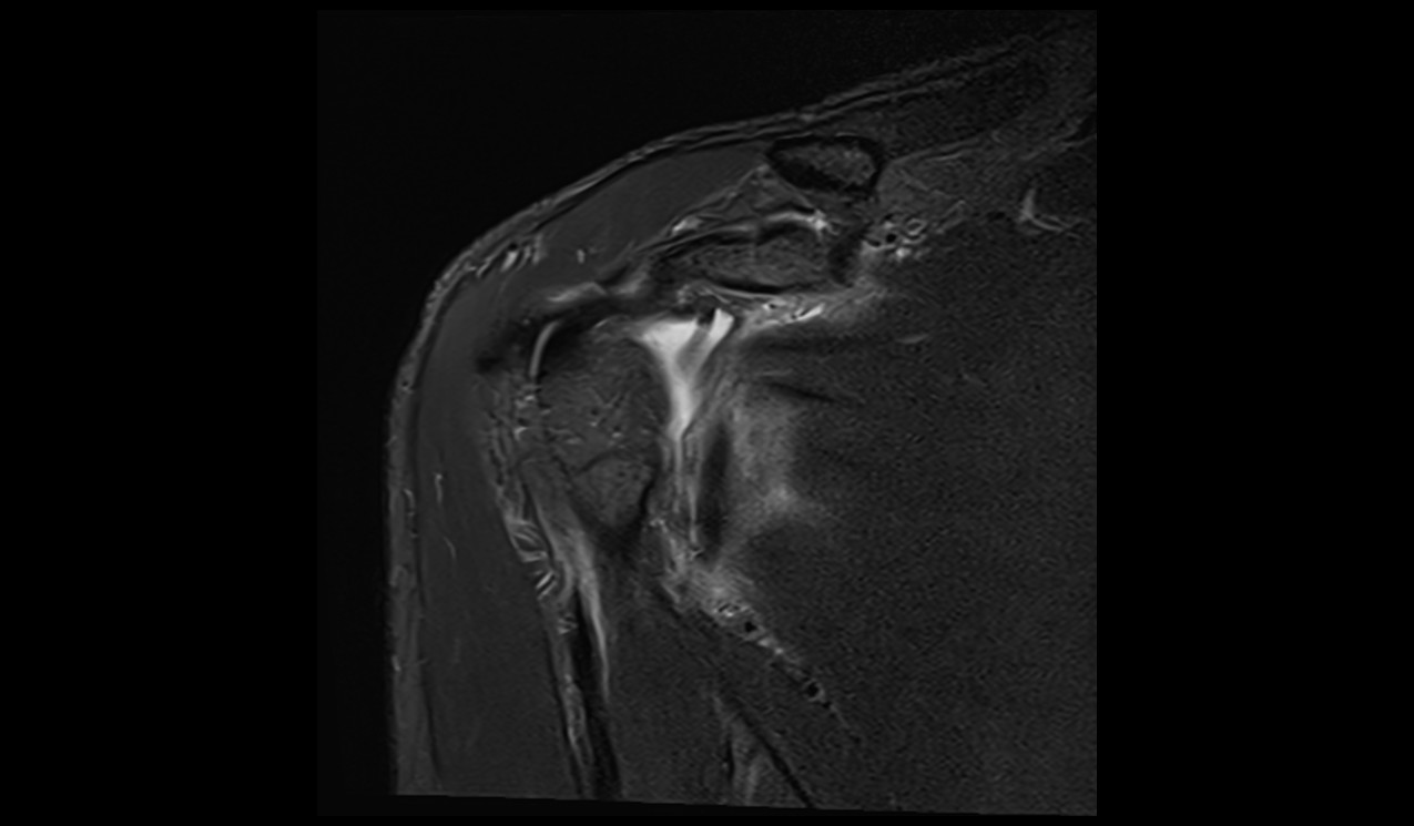 ALPSA Lesion MRI | Radiology Article on Anterior Labroligamentous ...