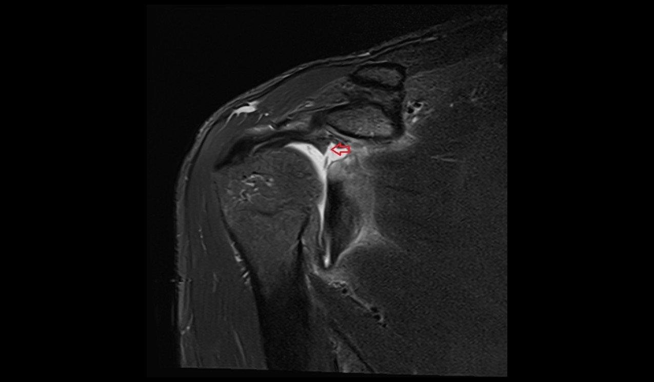 STIR coronal image shows ALPSA Lesion 2