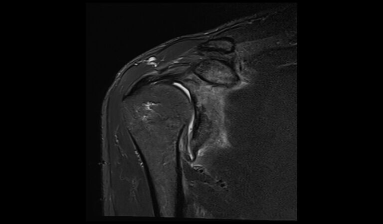 ALPSA Lesion MRI | Radiology Article on Anterior Labroligamentous ...