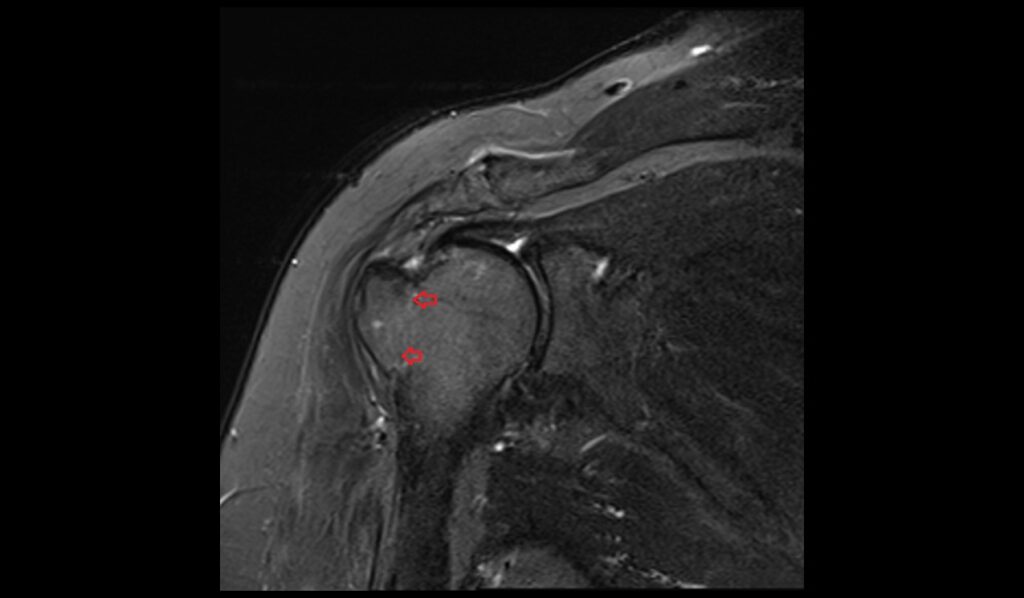 Greater Tuberosity Avulsion Fracture Mri 