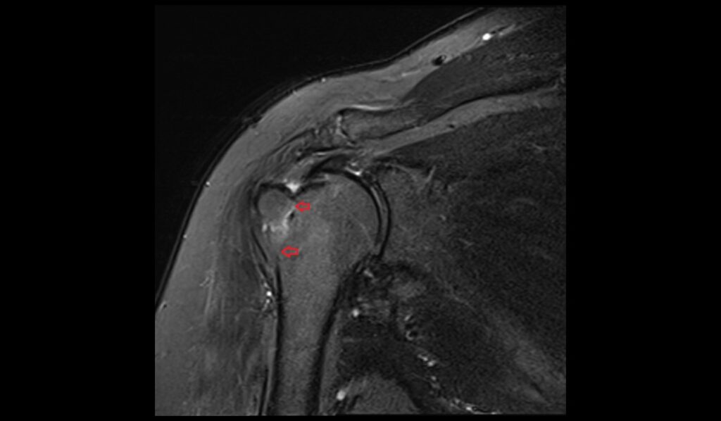 Greater Tuberosity Avulsion Fracture Mri 