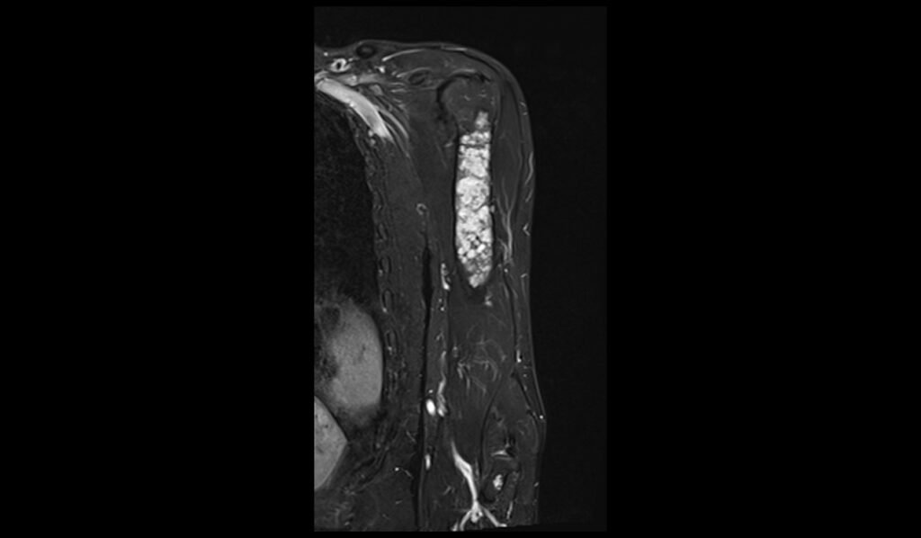 STIR coronal image shows Humerus Polyostotic Fibrous Dysplasia 1