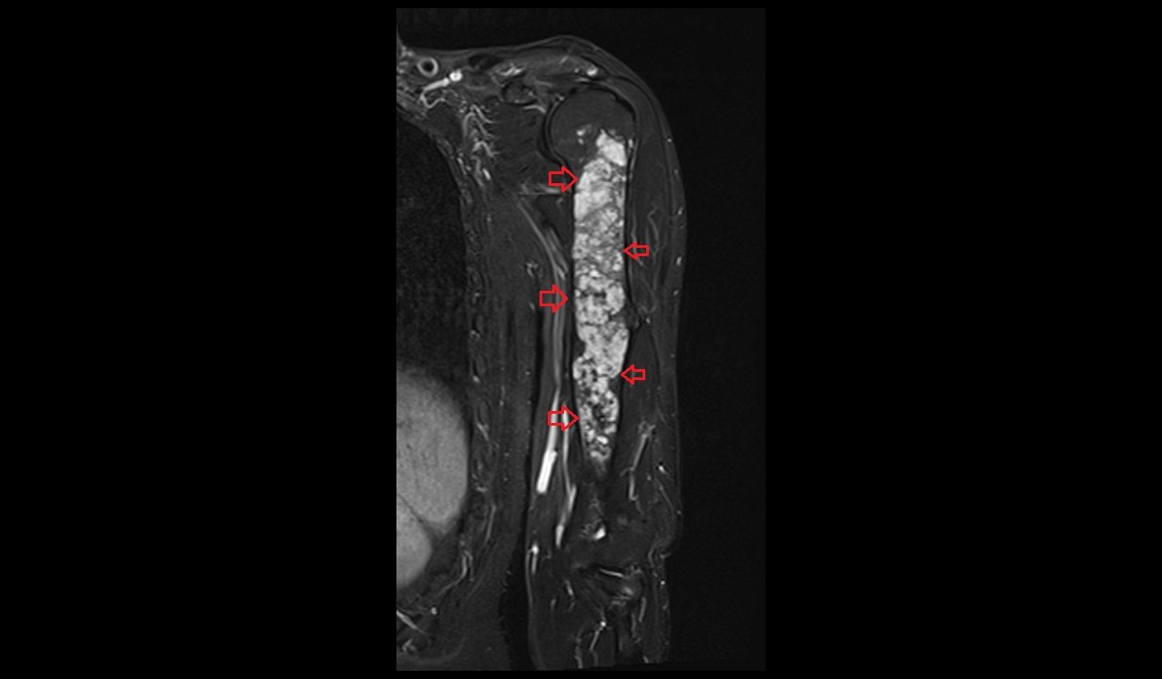 STIR coronal image shows Humerus Polyostotic Fibrous Dysplasia