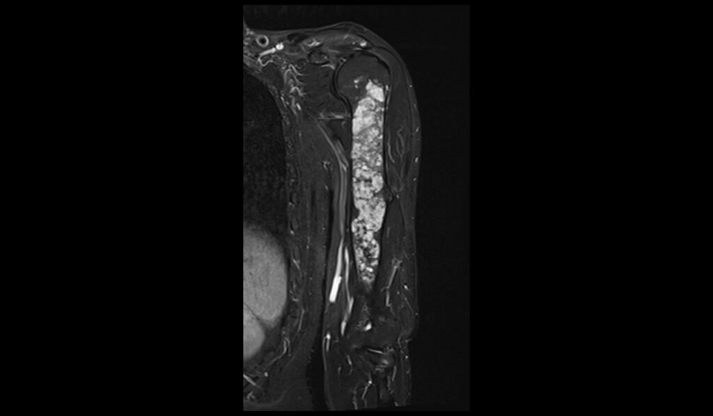 STIR coronal image shows Humerus Polyostotic Fibrous Dysplasia 2