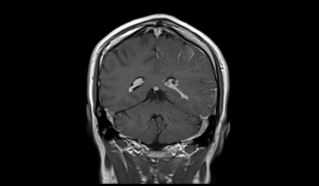 Sturge-weber Syndrome Mri 