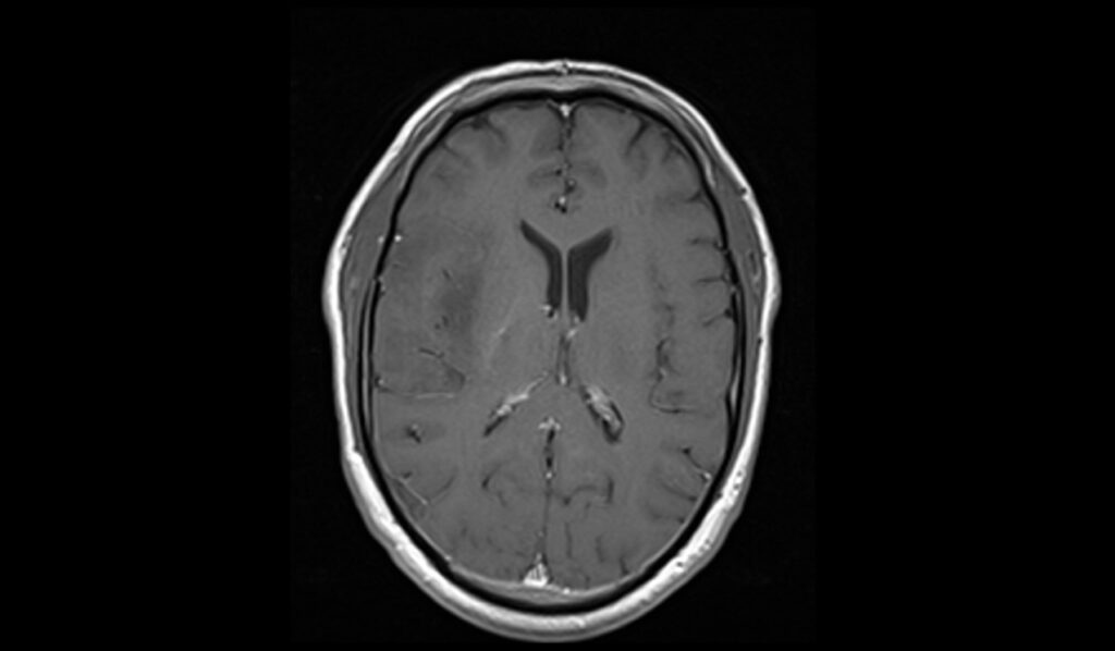 Oligodendroglioma MRI | Radiology Article on Oligodendroglioma