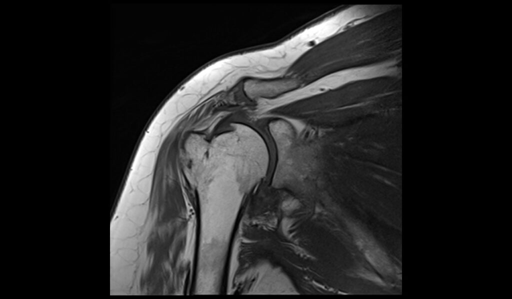 Greater Tuberosity Avulsion Fracture MRI | Radiology Article on Greater ...