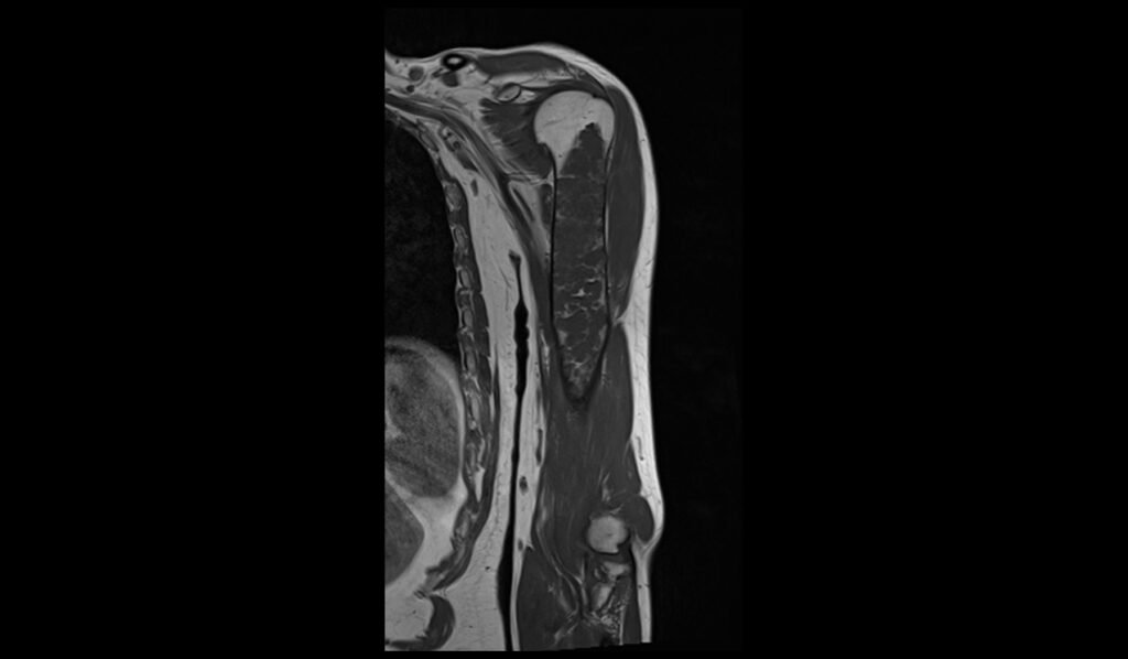 T1 coronal image shows Humerus Polyostotic Fibrous Dysplasia 1